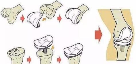 名医专访丨上海六院骨科刘万军：膝关节置换常见问题