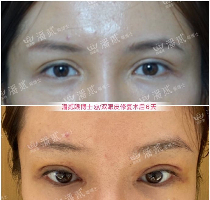 割了开扇双眼皮眼尾上扬太宽,眼尾上扬的眼睛适合什么双眼皮