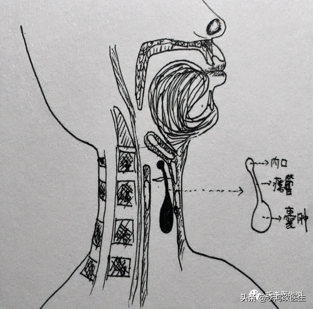 男子怪病脖子穿孔吃啥漏啥，神医还来骗钱，最终找我：被误诊25年