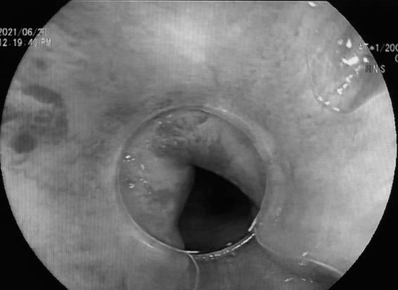 南大二附院消化内科谢正元教授团队完成院内首例内镜下弥漫性直肠静脉畸形扩张出血硬化剂注射止血术