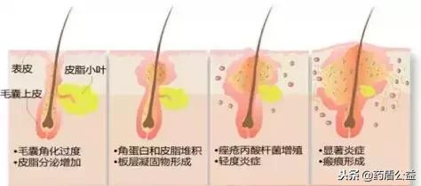 40岁青春痘去掉小妙招一分钱不花,12岁到15岁青春痘疤痕怎样消除