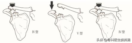 武磊左肩骨错位韧带撕裂,武磊首次回应左肩伤势