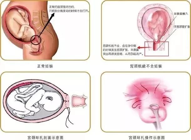 宫颈口太松需要治疗吗,宫颈松能自行恢复么