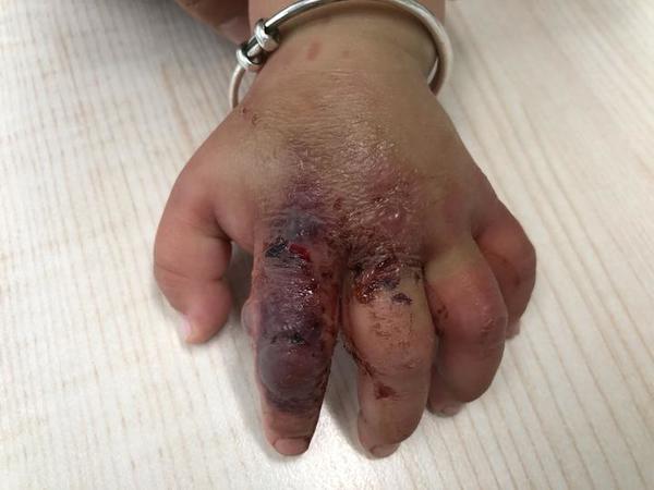 奶奶给孙子擦药,奶奶给孙子涂药