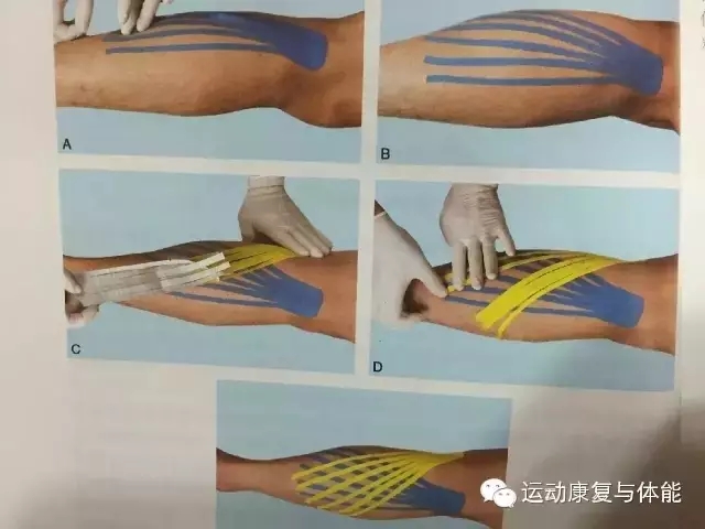 跟腱松解康复师,跟腱断裂康复训练教授