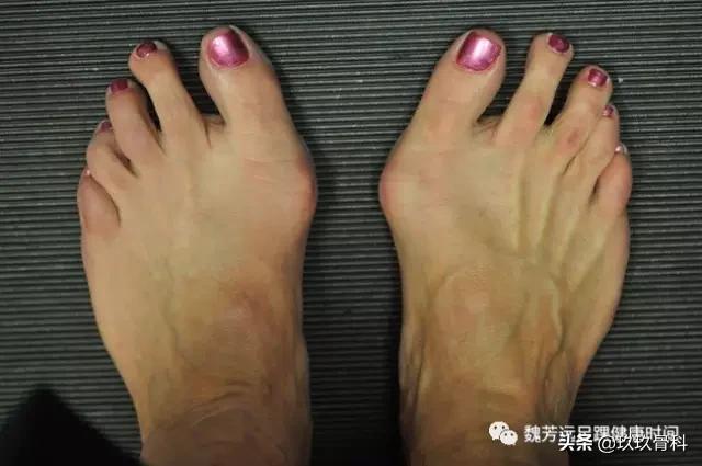 拇外翻大脚骨矫正工具正确用法,拇外翻和大脚骨有什么区别