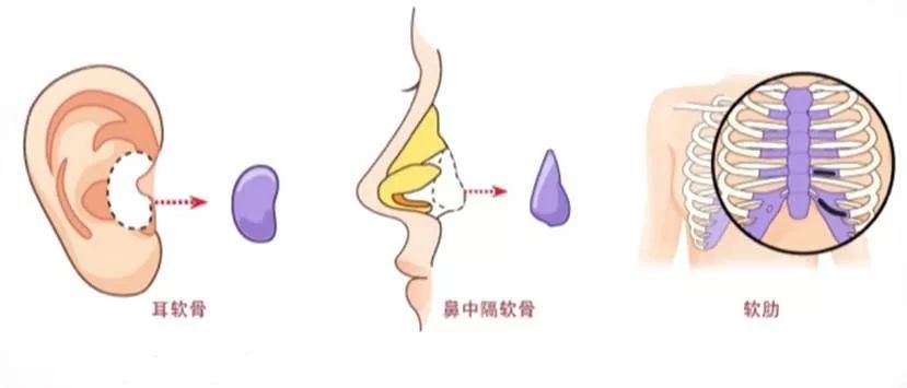 耳软骨隆鼻和肋软骨隆鼻图片对比,耳软骨隆鼻和假体耳软骨隆鼻