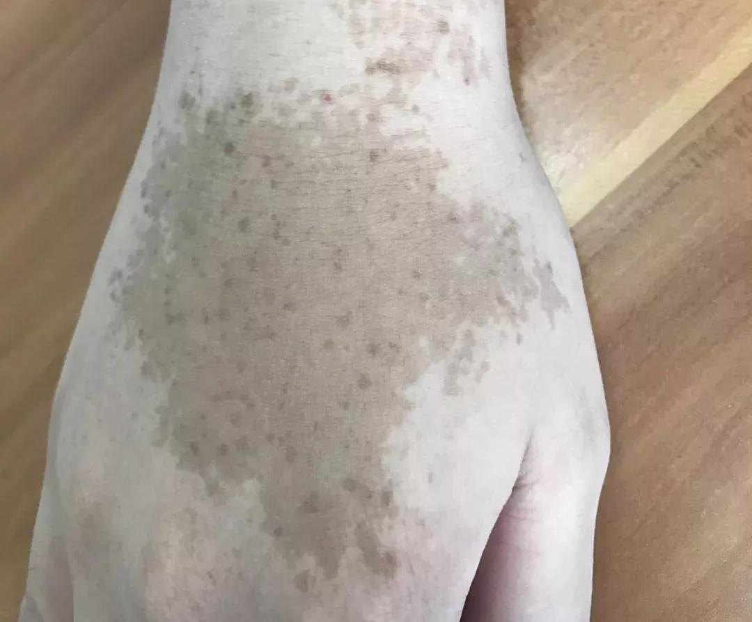 雀斑样痣是雀斑的一种吗,雀斑痣和健康痣有什么区别