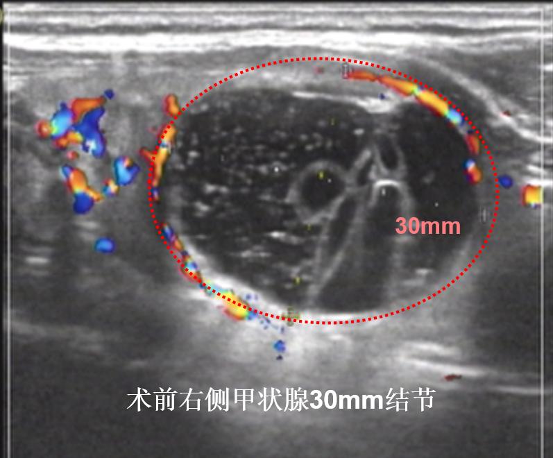 甲状腺结节微创消融手术,甲状腺结节微创消融医保
