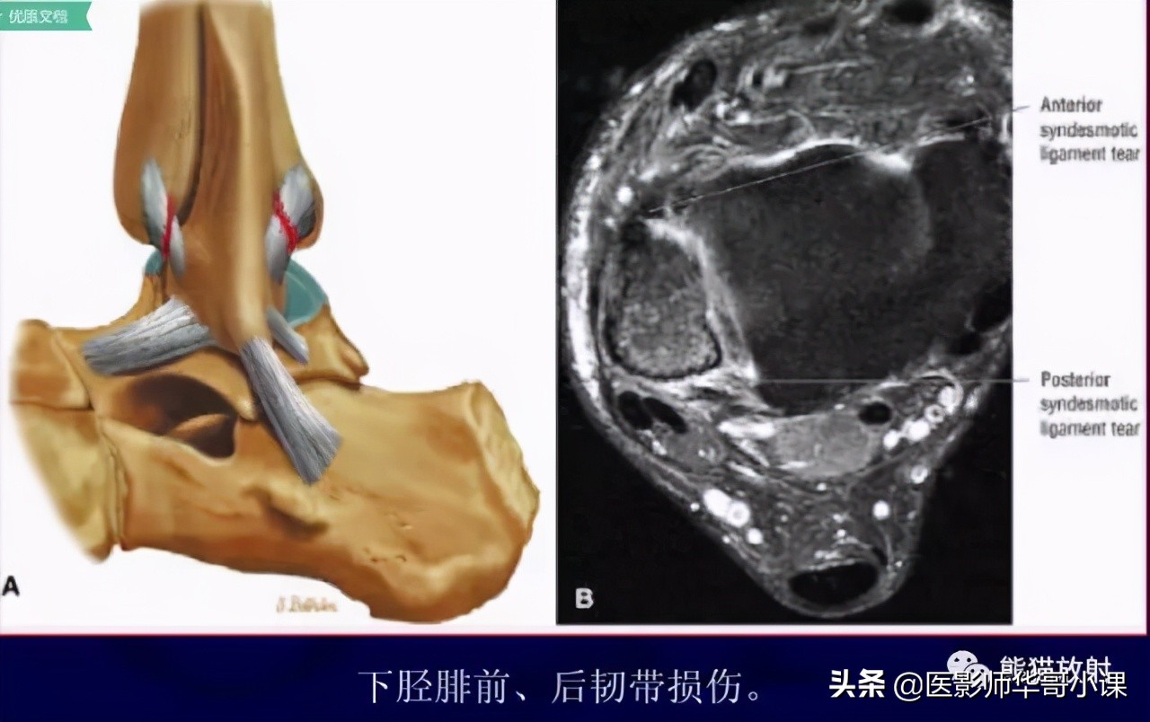 踝关节解剖视频课,解剖学韧带分布图