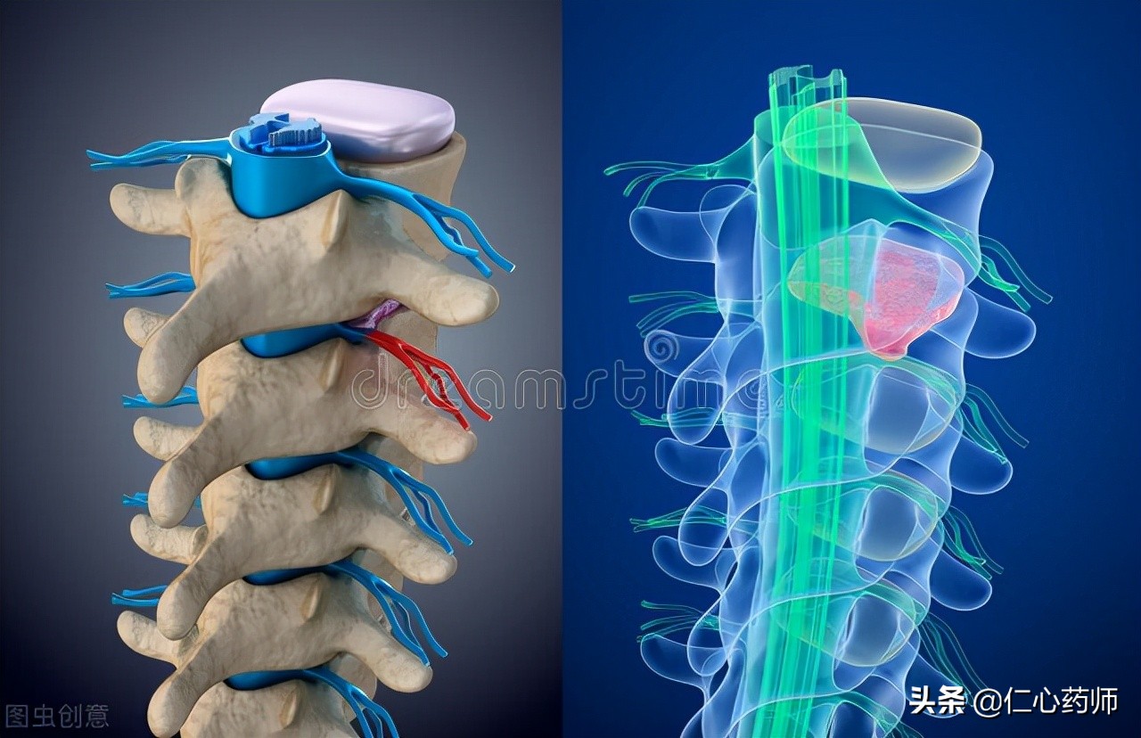 颈椎椎间盘突出的建议,椎间盘突出不建议推拿