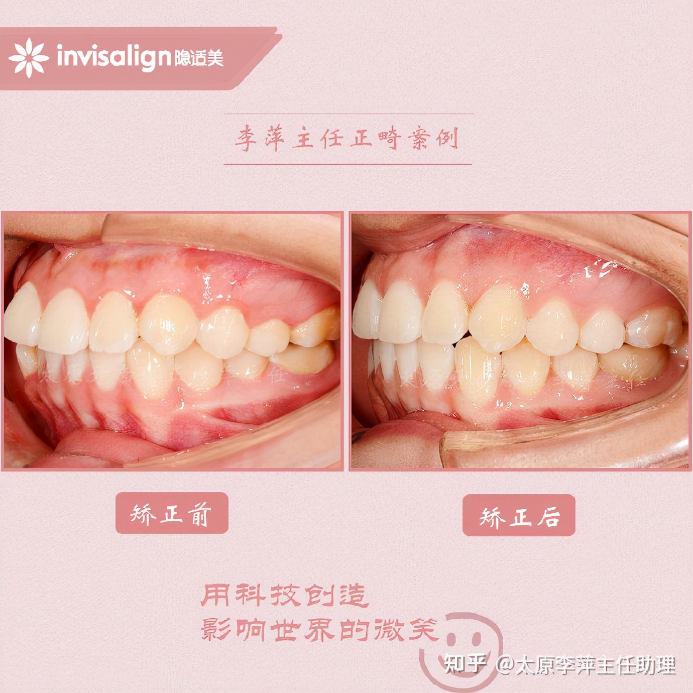 太原牙齿矫正靠谱吗,太原成人隐形牙套牙齿不齐
