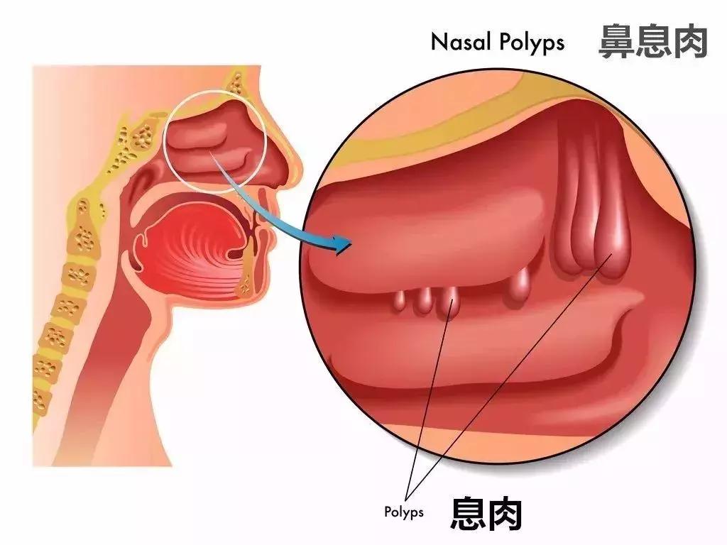 什么情况下有息肉会癌变,哪些部位长息肉最严重