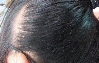 如何去除头上的虱子和虱卵,虱子的生成过程及去除头虱的方法