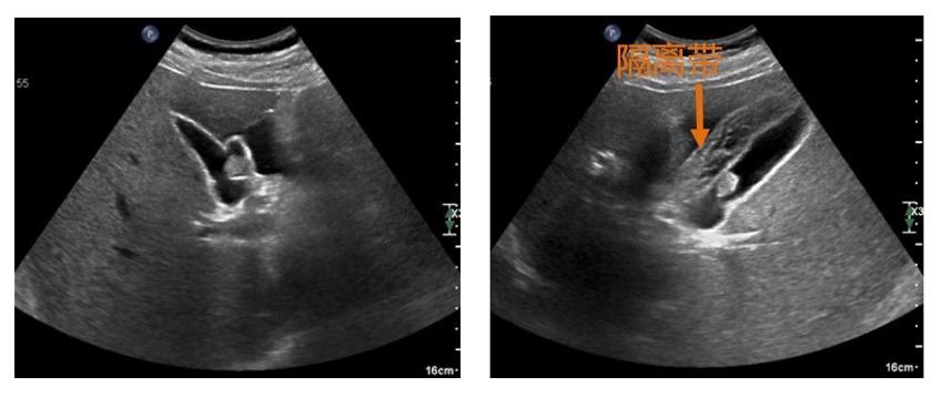 胆囊息肉消融保胆有效吗,胆囊息肉消融保胆有用吗