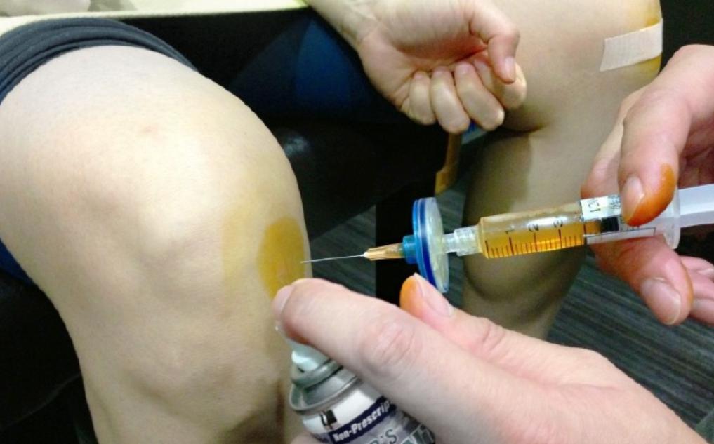 prp治疗骨关节炎一般几针,prp治疗骨关节炎多少钱一针