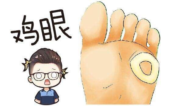 鸡眼掉了会残留吗,鸡眼处理方法推荐