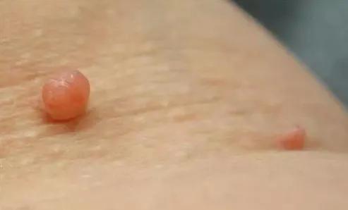 丝状疣是什么--丝状疣是什么原因引起的?