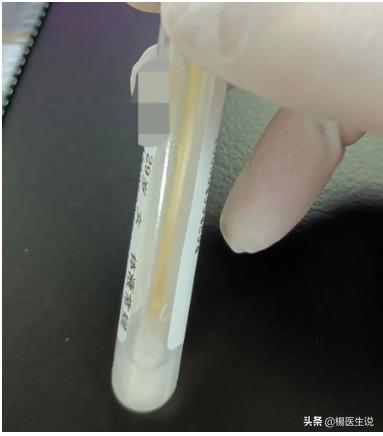 真实病例：滴虫合并霉菌性阴道炎，实属少见