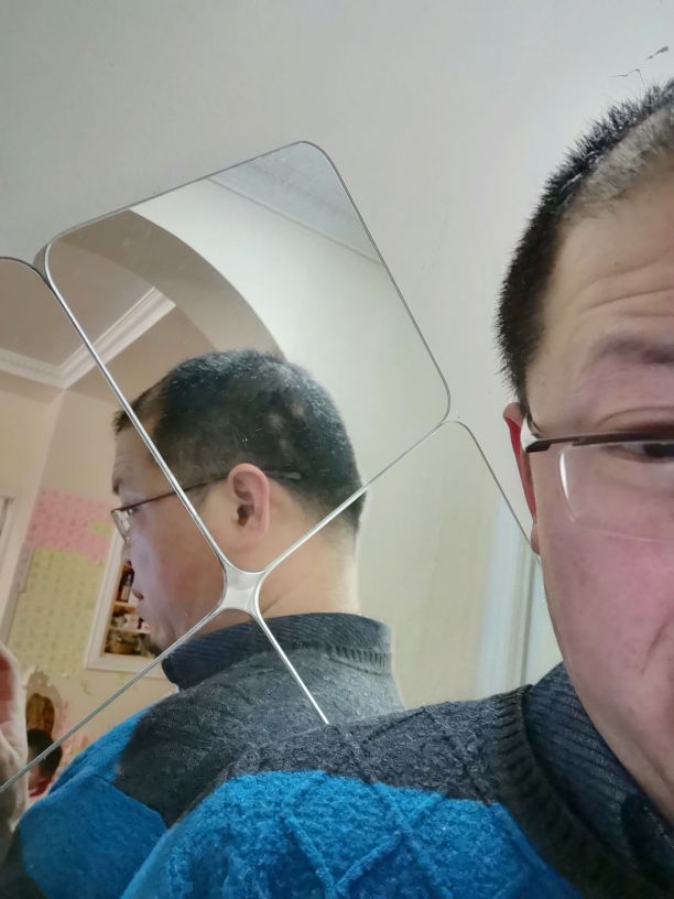 发现斑秃刚好又开始掉头发怎么办,突然发现斑秃怎么治疗