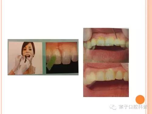 有牙洞用含氟牙膏,牙齿涂氟小知识