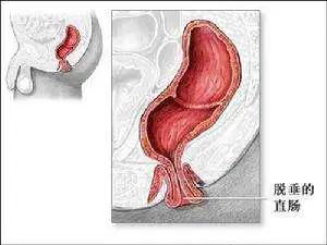 大便堵在肛门排便不尽,甲硝唑栓能治肛门坠胀大便不尽吗