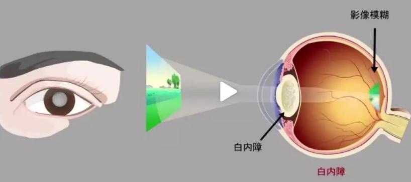 年轻人白内障是什么原因引起来的,年轻人也得白内障么