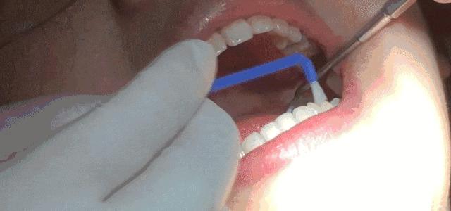 牙齿有白色斑点怎么办,孩子牙齿出现白色怎么回事