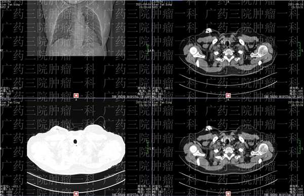 广药三院肿瘤一区靠谱吗,广药三院肿瘤成功案例