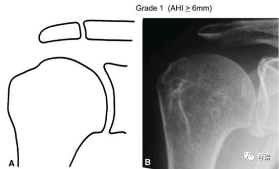 巨大肩袖撕裂概念图,右肩袖巨大撕裂