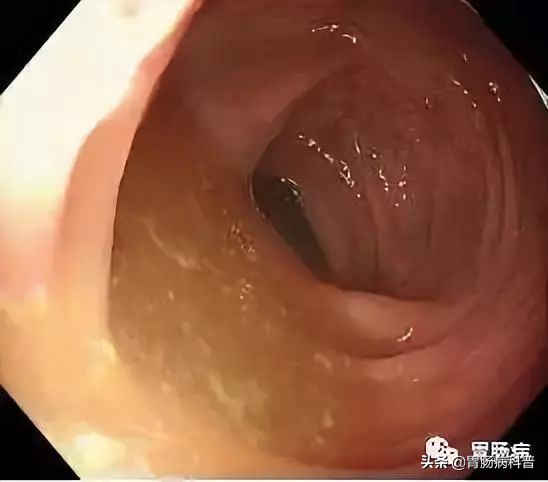 做肠镜是怎么清肠的,做肠镜如何能清肠