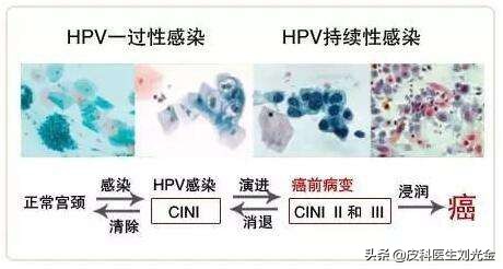 hpv宫颈癌怎么治疗,宫颈癌是hpv持续感染才会得的吗