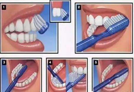 矫正牙齿是如何戴牙套的,矫正牙齿戴牙套需要注意事项