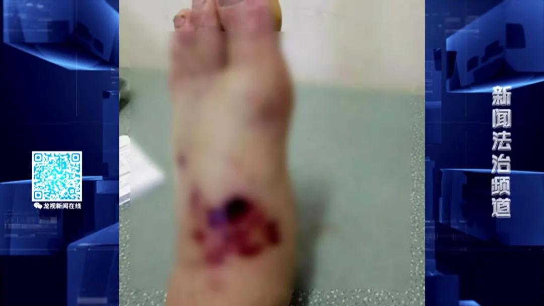 46岁男子双腿被砸成重伤,哈尔滨一男子被砖头砸