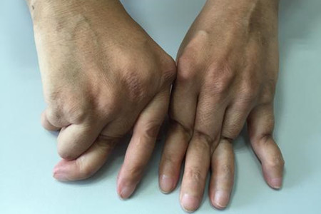 类风湿怎样才算控制住了不再复发,类风湿真的就治不好了吗