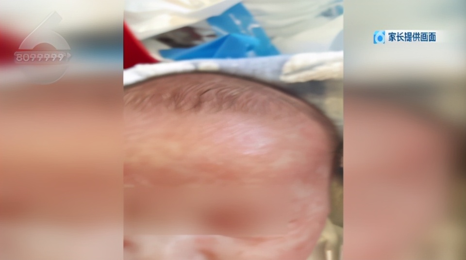 婴儿耳朵和嘴巴一圈红肿,婴儿吃药后嘴巴边上都红肿