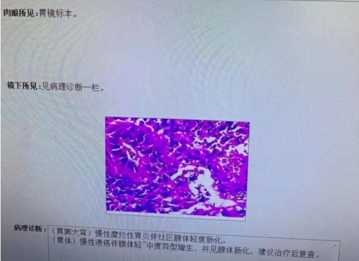 胃体溃疡、糜烂，患者不配合医生治疗，几个月后恶化成早癌