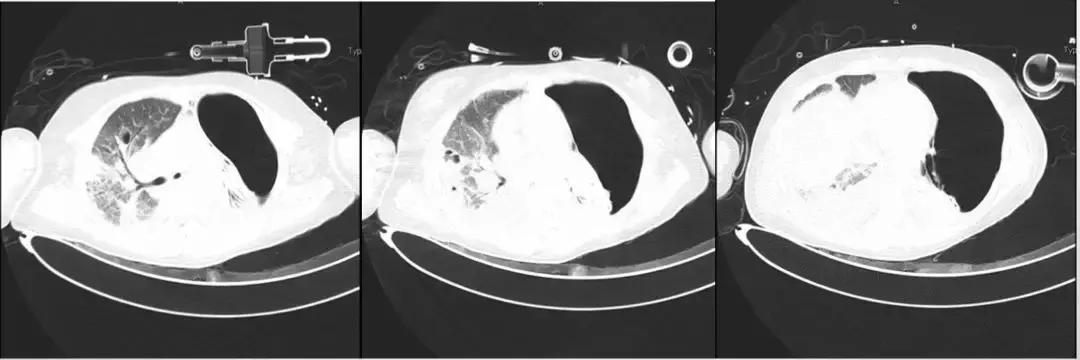 万古霉素用于mrsa的作用机制,万古霉素无效还有什么抗生素可用