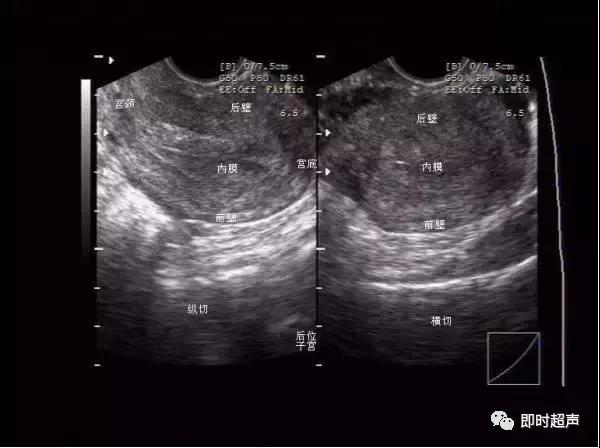 阴部超声检查什么时候做,妇科阴式超声检查方法