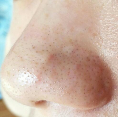 鼻子闭口黑头去除小妙招,鼻子黑头小方法轻松解决