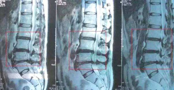 腰突压迫神经导致脚疼怎么办,脚痛无法形容的痛