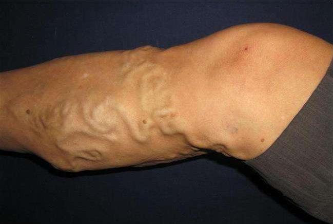 腿上血管像蜘蛛网一样怎么回事,腿上血管像蚯蚓