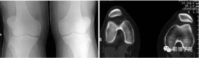 膝关节疼痛的问题各种各样的图片,膝关节疼痛的16种最常见原因速查