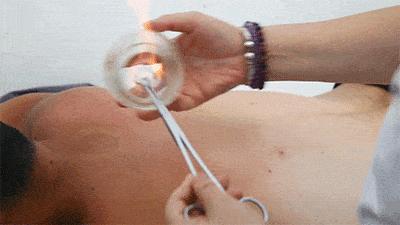 拔罐减肥瘦了30斤食谱,拔罐减肥一周能瘦多少