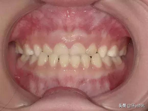 乳牙地包天会自动好吗,乳牙地包天矫正活动器