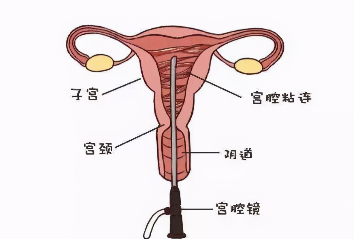 月经量少宫腔粘连可以调理吗,月经量减少宫颈粘连