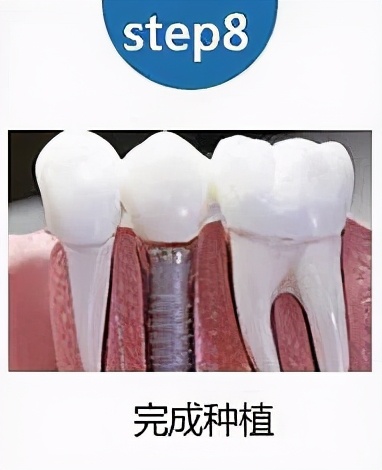 老人家种牙去哪里最好,50岁种牙最好方法怎么种