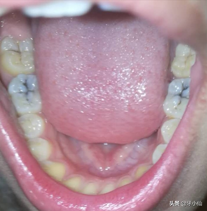 小孩子吃多了糖长虫牙,吃糖果不刷牙会有虫牙吗