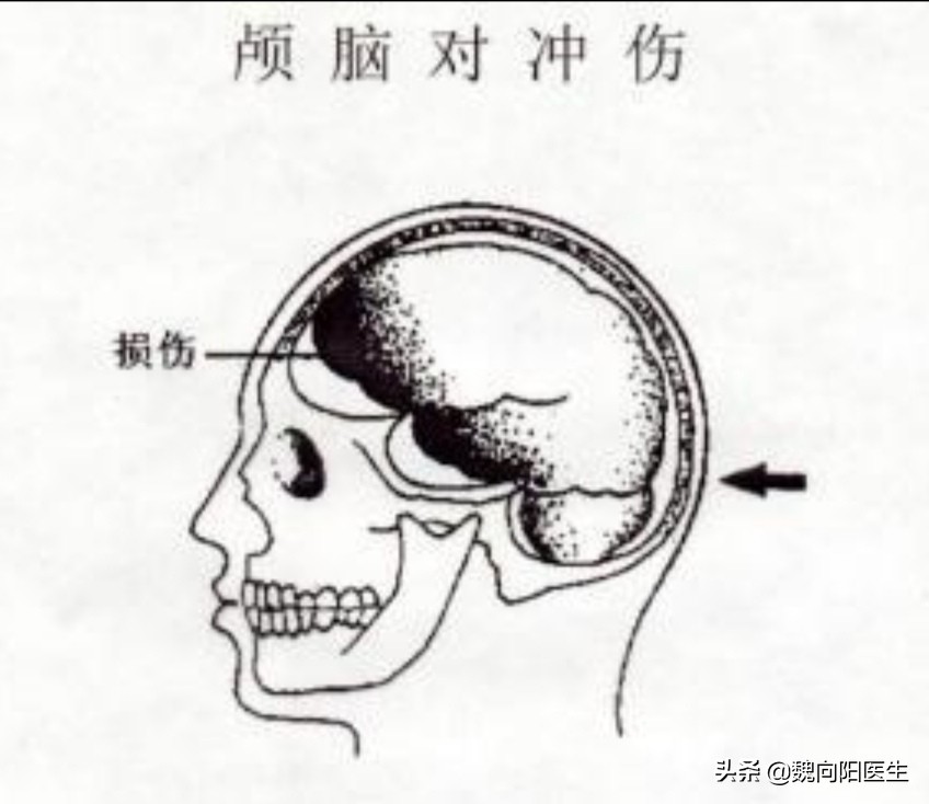 后脑勺着地很危险的,为什么后脑勺着地危害大