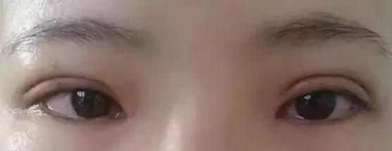 全切双眼皮修复过程经历真实,双眼皮失败修复费用由谁承担